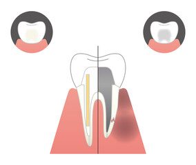 戸塚の歯医者、みずの歯科クリニックの根管治療