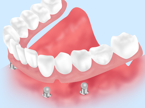 戸塚の歯医者、みずの歯科クリニックで入れ歯治療