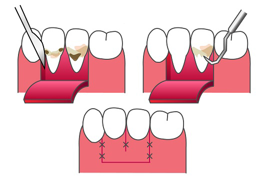 戸塚の歯医者、みずの歯科クリニックの歯周病