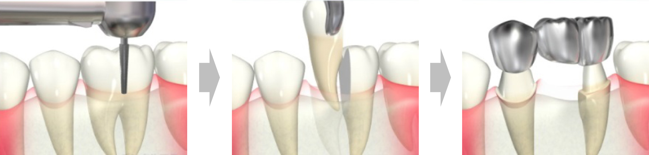 戸塚の歯医者、みずの歯科クリニックのMI治療