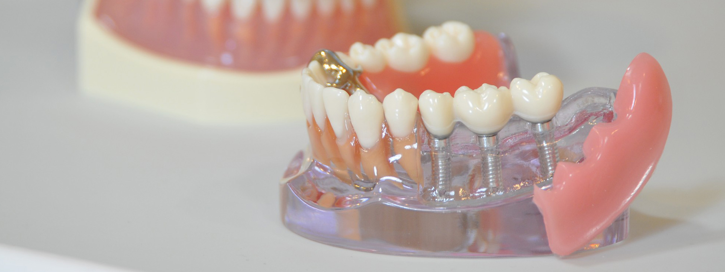 戸塚の歯医者、みずの歯科クリニックのインプラント治療