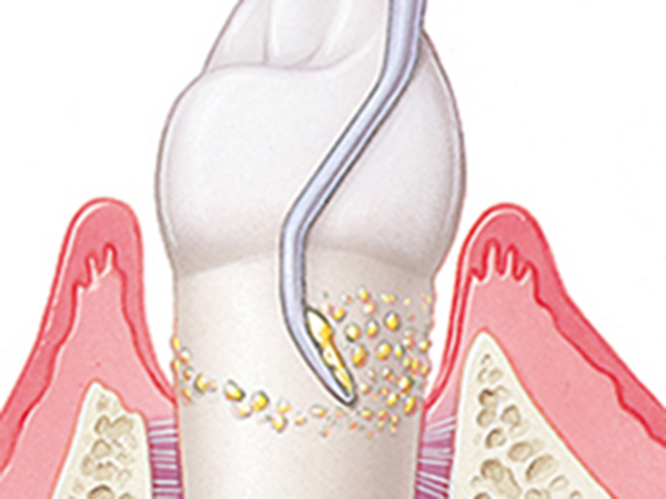戸塚の歯医者、みずの歯科クリニックの歯周病