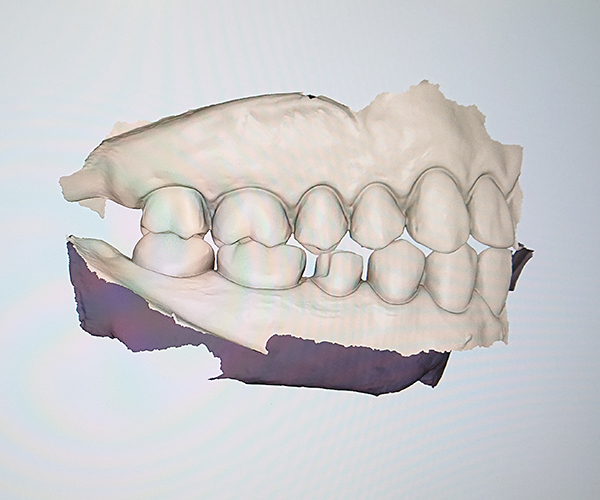 戸塚の歯医者、みずの歯科クリニックの口腔内スキャナー