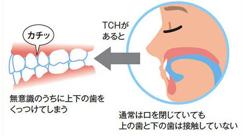 戸塚の歯医者、みずの歯科クリニックの歯列接触癖対策