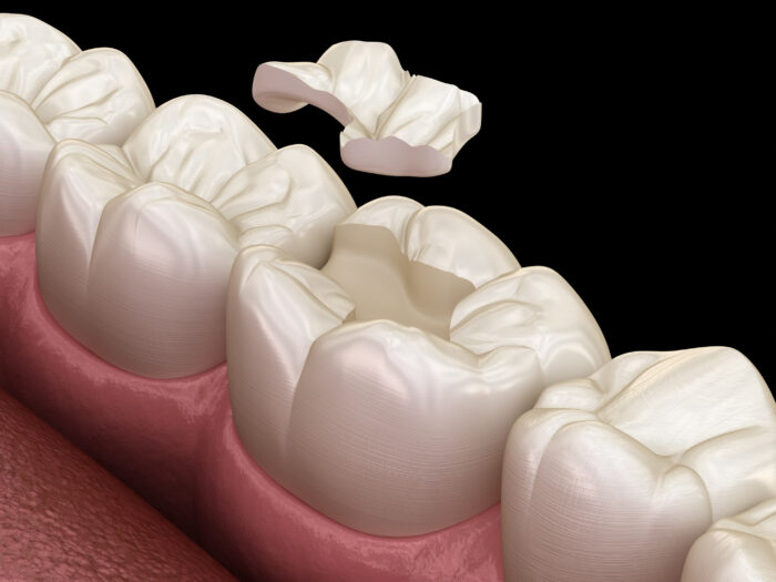 戸塚の歯医者、みずの歯科クリニックの歯ぎしり対策