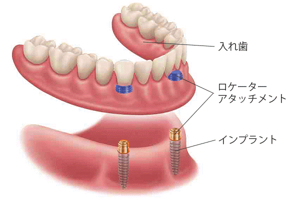 戸塚の歯医者、みずの歯科クリニックで入れ歯治療