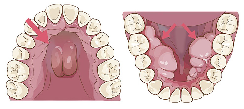 戸塚の歯医者、みずの歯科クリニックの歯ぎしり対策